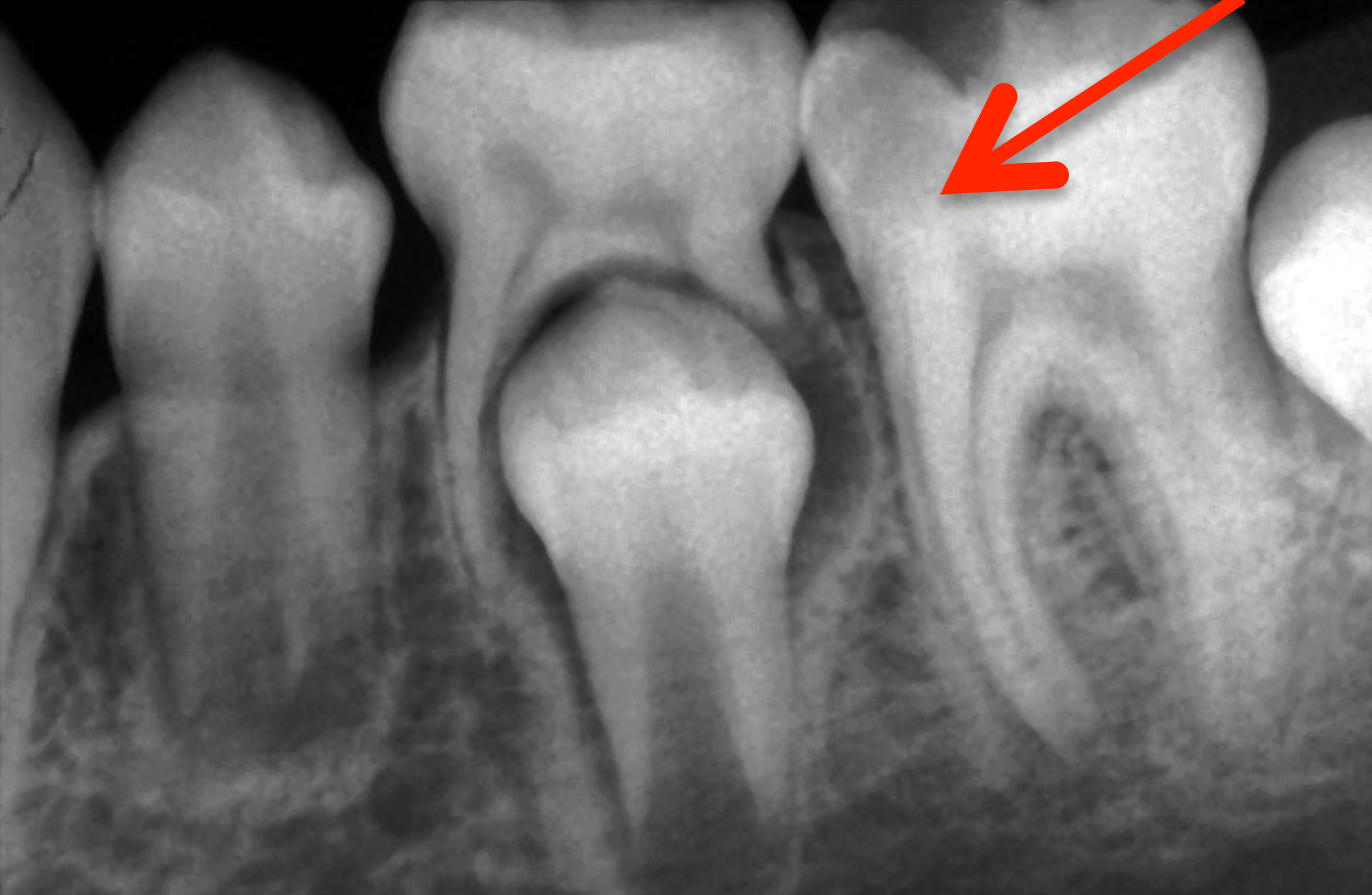 Cemento bioceramico con GEL - Neo MTA Plus 1 g